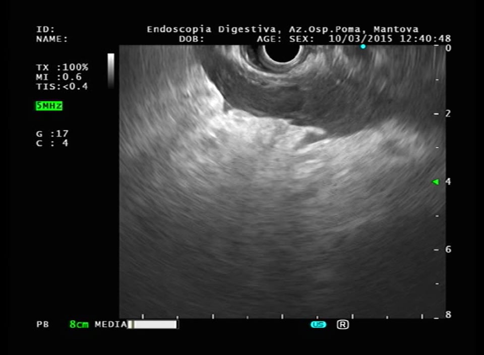 Pancreas_acute pancreatitis.mpg