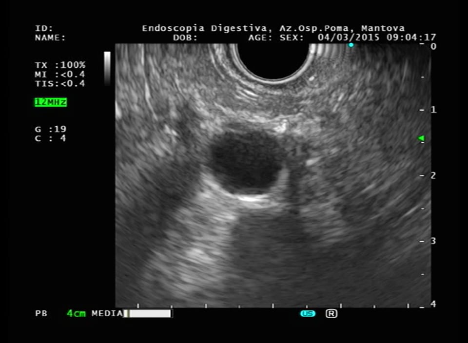 Pancreas_ serous cystadenoma.mpg