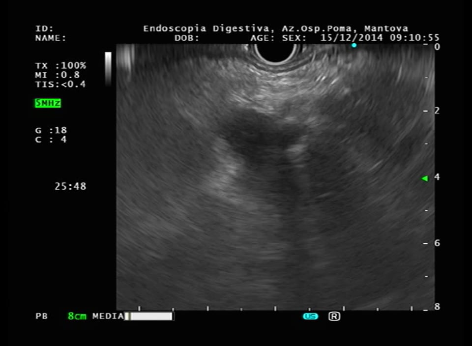 Liver_intrahepatic sludge.mpg