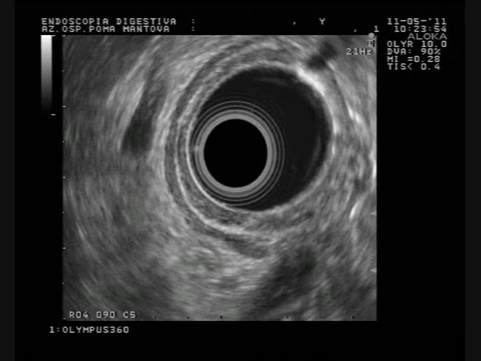 Esophagus_esophageal and periesophageal varices.wmv