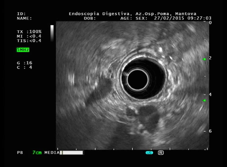 Stomach_perigastric varices.mpg