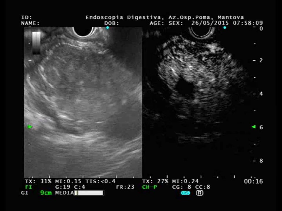 Stomach_leiomyosarcoma.wmv