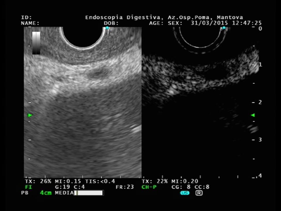 Stomach_cancer N2.MPG