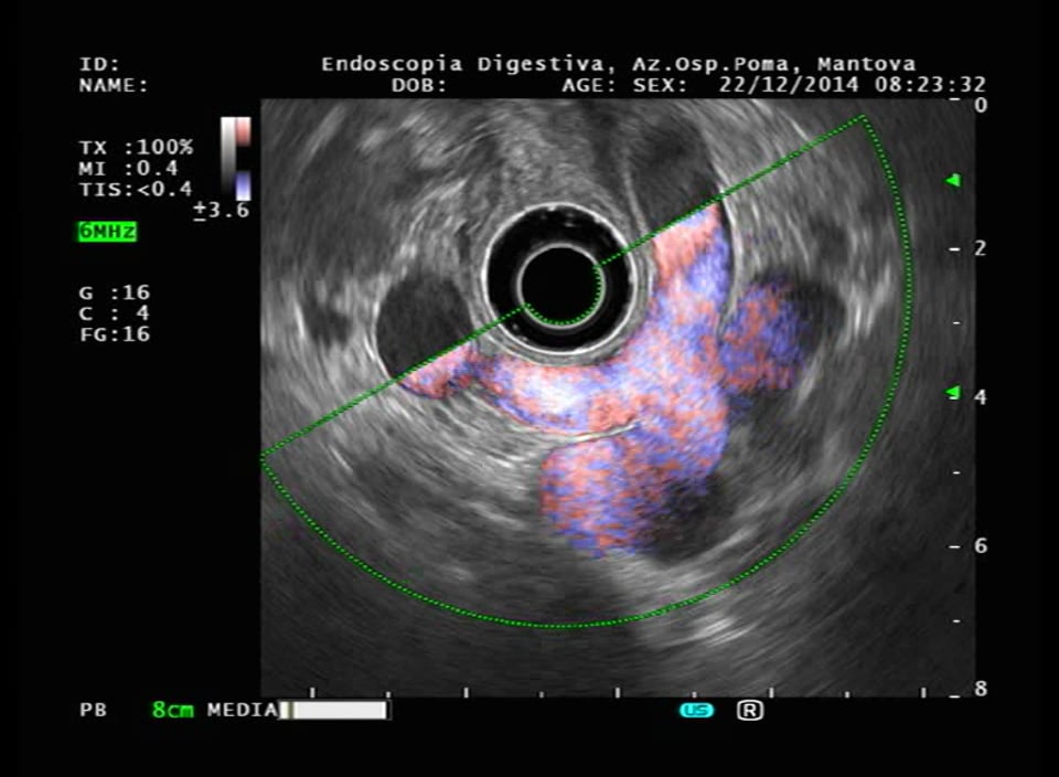 Stomach_ perigastric varices.mpg