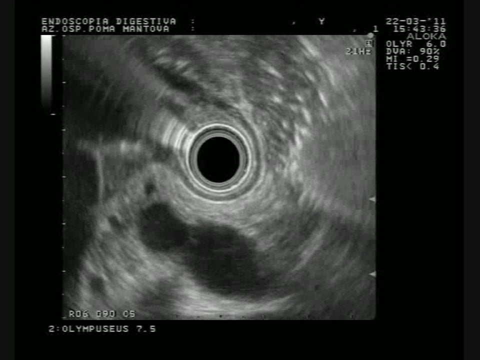 Splenic vein_dilation.wmv